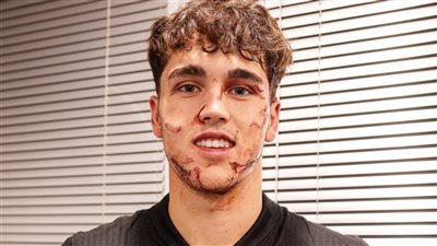 إصابة كوبارسي تثير القلق في برشلونة قبل مواجهة ريال سوسيداد بالدوري الإسباني