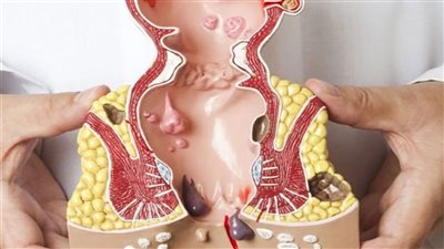 هل يمكن علاج البواسير في المنزل؟.. إجراءات تساعد على التخفيف من الأعراض