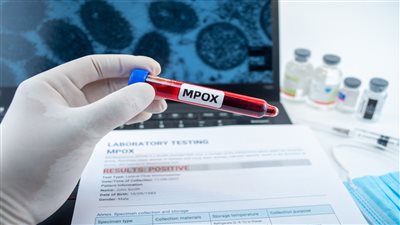 كندا تعلن تسجيل أول حالة مؤكدة من سلالة جدري القرود mpox
