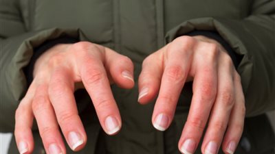 أسباب برودة الأطراف في الشتاء وطرق الوقاية منها