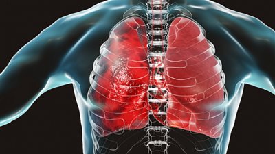 طبيب روسي: كيف نحمي أنفسنا من الالتهاب الرئوي الناتج عن الأنفلونزا؟