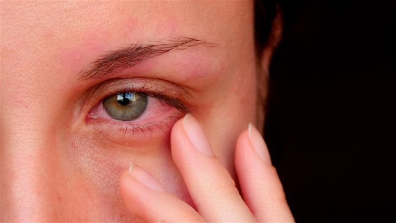 علاج حساسية العين