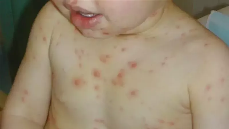 علاج جدري الماء عند