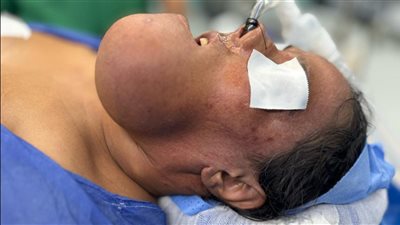 نجاح جراحة دقيقة لإزالة ورم نادر من فك مريضة بمستشفى الشيخ زايد التخصصي