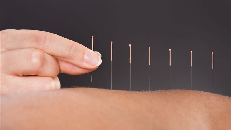 مراكز الإبر الصينية
