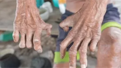 مُعدي أم لا ، ما هو مرض الجذام وعدد المصابين في مصر؟ (فيديو)