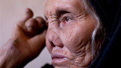 ما هو مرض الجذام وما هي اعراضه، توضيح من الصحة 