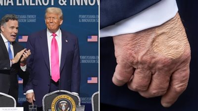 تفاصيل الحالة الصحية لترامب، هل يعاني الرئيس الأمريكي من مرض خطير؟