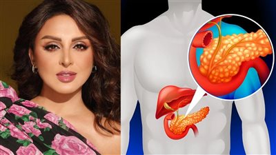 بعد شائعة إصابة أنغام بالمرض، ما هو سرطان البنكرياس؟