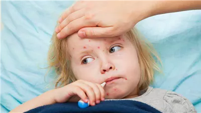 شبح الحصبة والسل يطل من جديد، كيف عادت الأمراض الماضية لتُهدد حاضرنا؟  