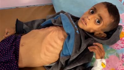 غزة تحارب مرض شلل نادر حاد في ظل حصار الاحتلال الإسرائيلي