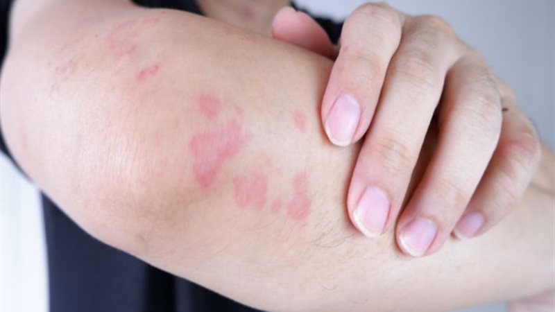 حساسية المضادات الحيوية