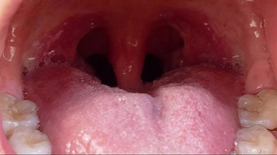 دراسة جديدة، البكتيريا داخل فمك قد تسبب نوبة قلبية