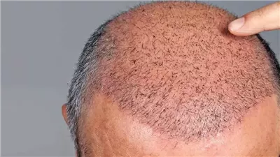 سعر زراعة الشعر في مصر 2026، هوس النساء يرفع العملية لـ300 ألف جنيه
