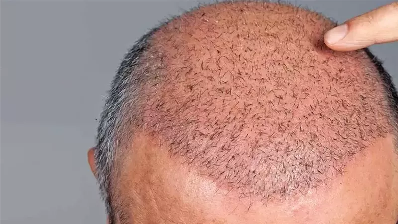 سعر زراعة الشعر في