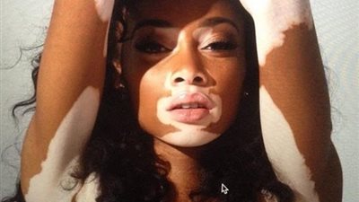 هل مرض البهاق خطير وما سبب ظهوره؟ 