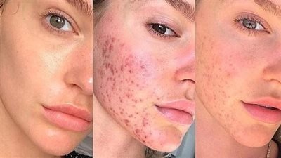 حب الشباب، حقنة جديدة تعالج المرض وتمنع ظهور البقع في الوجه ما القصة؟