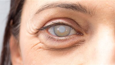 الصحة: 20 ألف عملية مياه بيضاء و124 زراعة قرنية ضمن إنجازات 