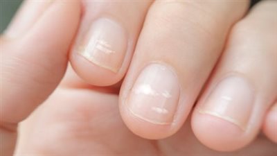 أظافر هشة وتعب مستمر وأسنان ضعيفة، تعرف على أعراض نقص الكالسيوم في الجسم