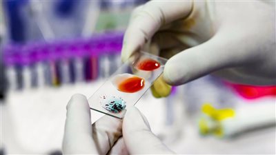 فصيلة الدم، هل يمكن أن تكون سببا لإصابتك بالسكتة الدماغية؟