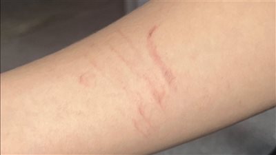 كسرت العكاز على ابني وبيقولولي مريضة نفسية، أم تستغيث من معلمة بشبرا (صور)