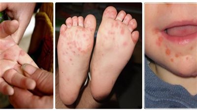 HFMD ينتشر بين الأطفال، تعرف على الأعراض وطرق الوقاية