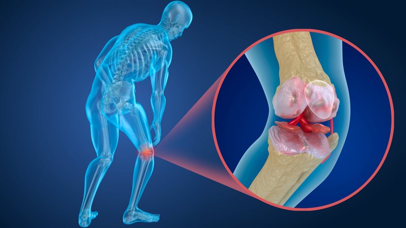 التهاب أعصاب الركبة