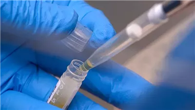 معجزة طبية بريطانية، اختبار دم جديد يكشف متلازمة التعب المزمن لأول مرة