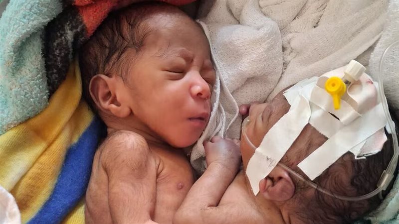 صبيان ملتصقان ولدا