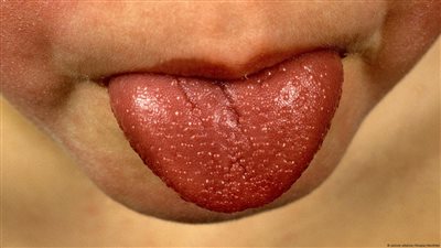 الحمى القرمزية.. عدوى بكتيرية، كيف يمكن الحد من انتقال العدوى بين التلاميذ؟