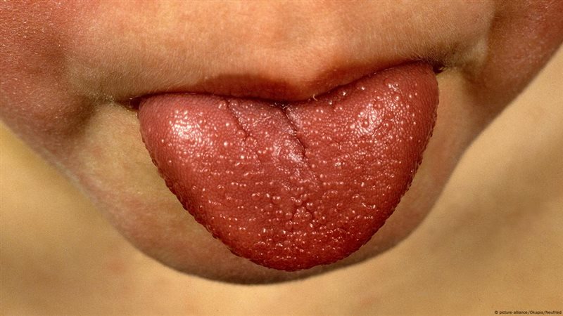 الحمى القرمزية 